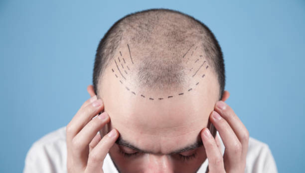 Hair Transplant